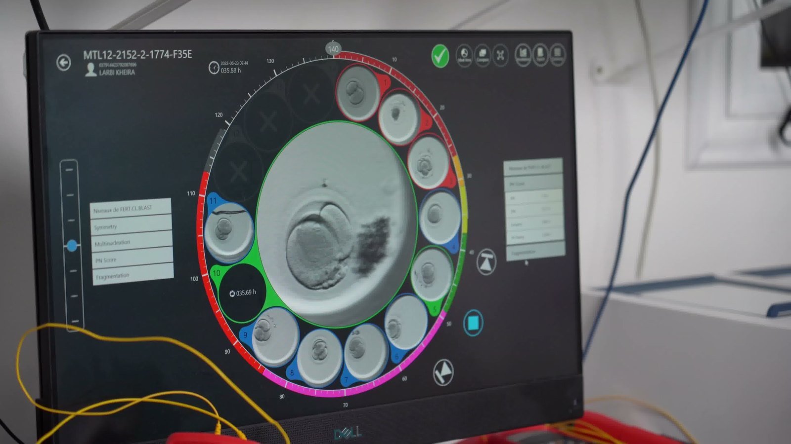 Suivi des embryons en time-lapse par Embryoscope